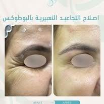 Botox — Rides d'expression — avant et après, cabinet Dr Sara Dahhouki, Fès