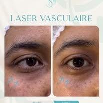 Laser vasculaire — avant et après, cabinet Dr Sara Dahhouki, Fès