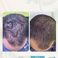 Traitement de la chute de cheveux — avant et après, cabinet Dr Sara Dahhouki, Fès